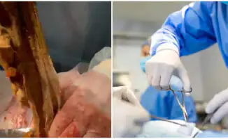 Забытое в животе: как салфетка стала невидимым врагом алматинки на протяжении 9 месяцев