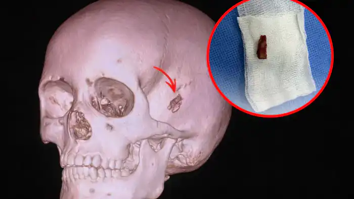 В Павлодаре медики извлекли из головы 10-летнего школьника 2-сантиметровый кусок дерева, который он носил в себе на протяжении 5 лет Павлодаре