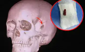 В Павлодаре медики извлекли из головы 10-летнего школьника 2-сантиметровый кусок дерева, который он носил в себе на протяжении 5 лет