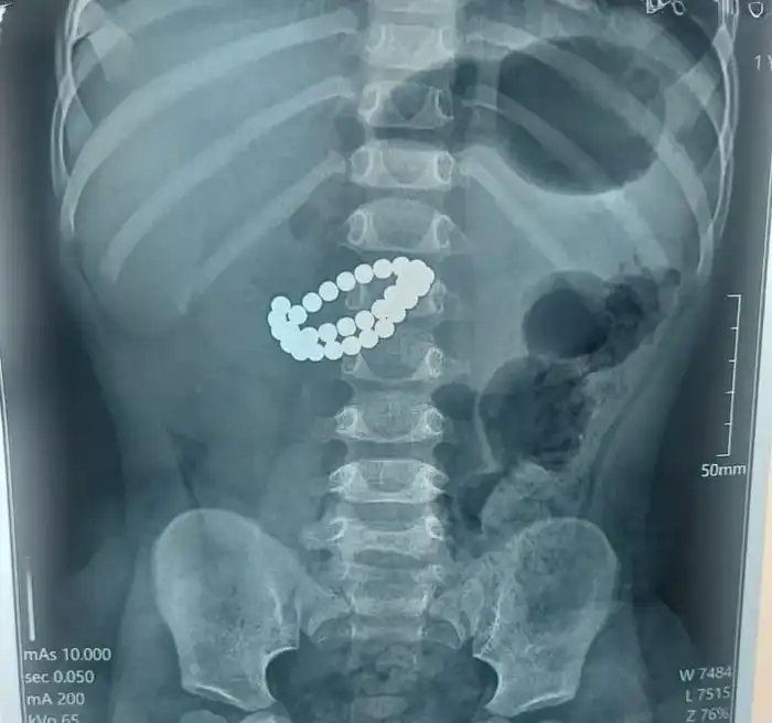 Экстренная операция в Алматы: хирурги спасли ребенка после проглатывания 31 магнита Павлодаре