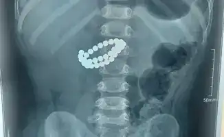 Экстренная операция в Алматы: хирурги спасли ребенка после проглатывания 31 магнита