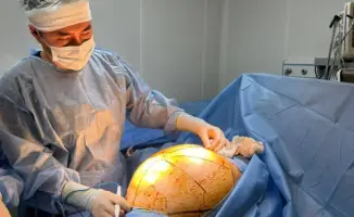 В АЛМАТЫ У ПАЦИЕНТКИ СМЕНИЛА СВОЮ СУДЬБУ ГИГАНТСКАЯ ОПУХОЛЬ В 25 КИЛОГРАММОВ