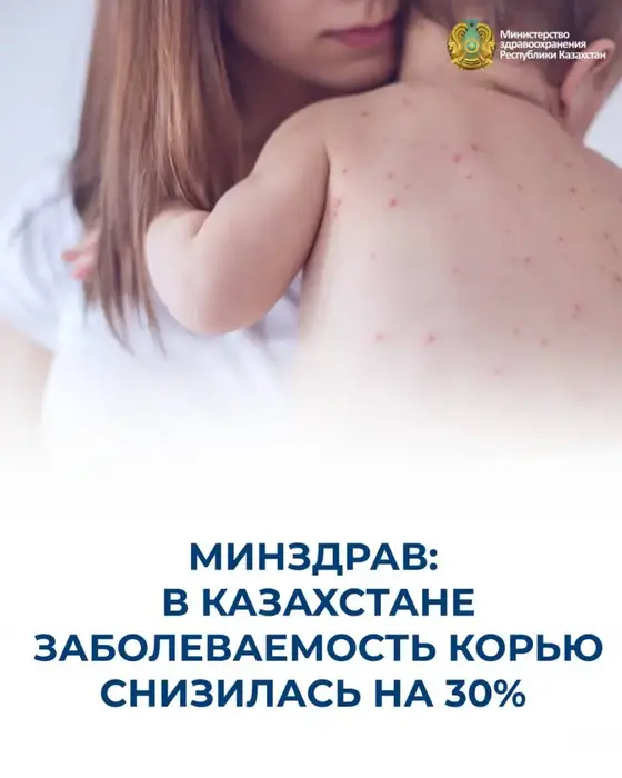 В Казахстане отмечается снижение заболеваемости корью на 30% за неделю